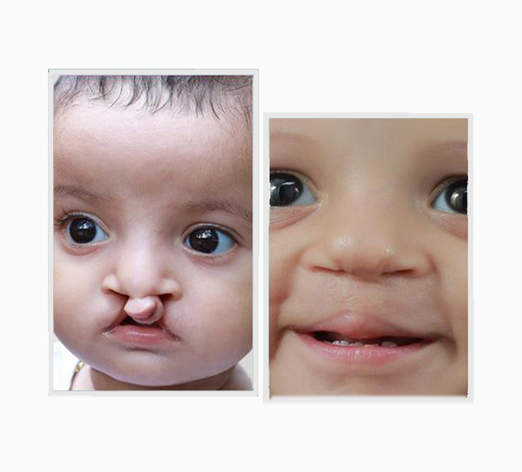 Cleft Lip Surgery