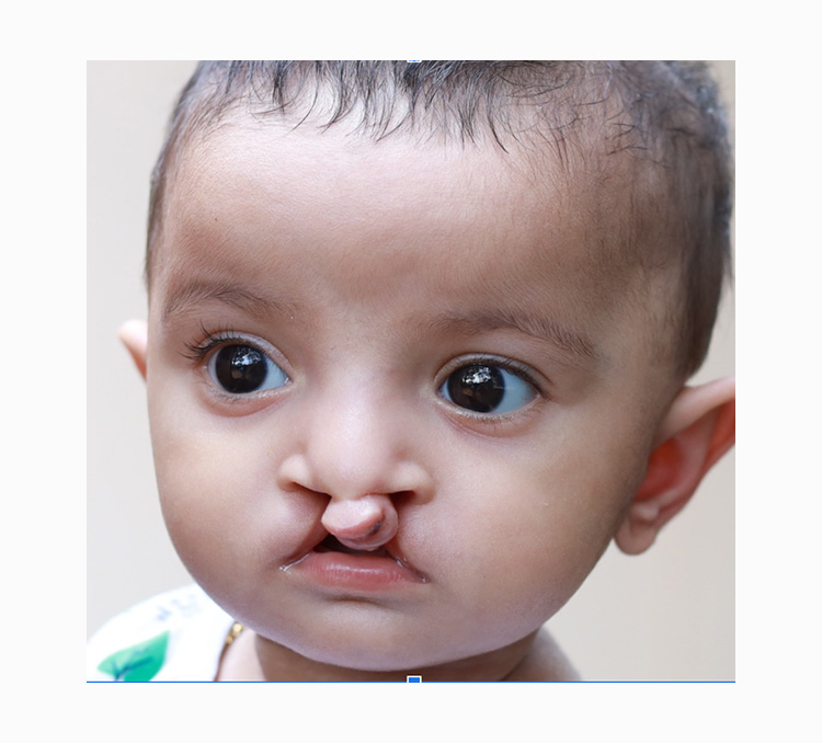 Cleft Palate Surgery