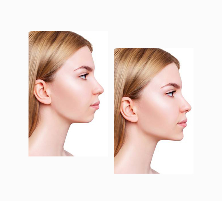 Jaw Surgery